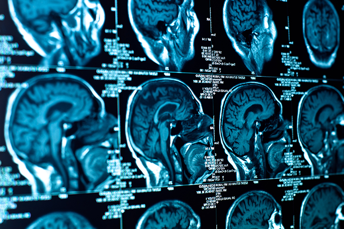 Rayos X de Daño Cerebral y Lesion